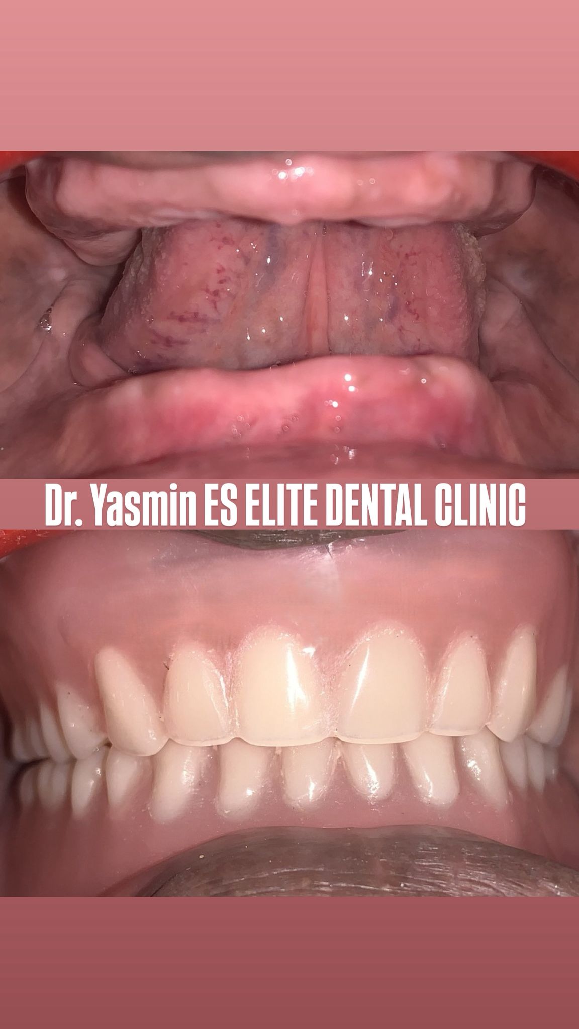 Surgical stage — maxillary anterior implants (placement)