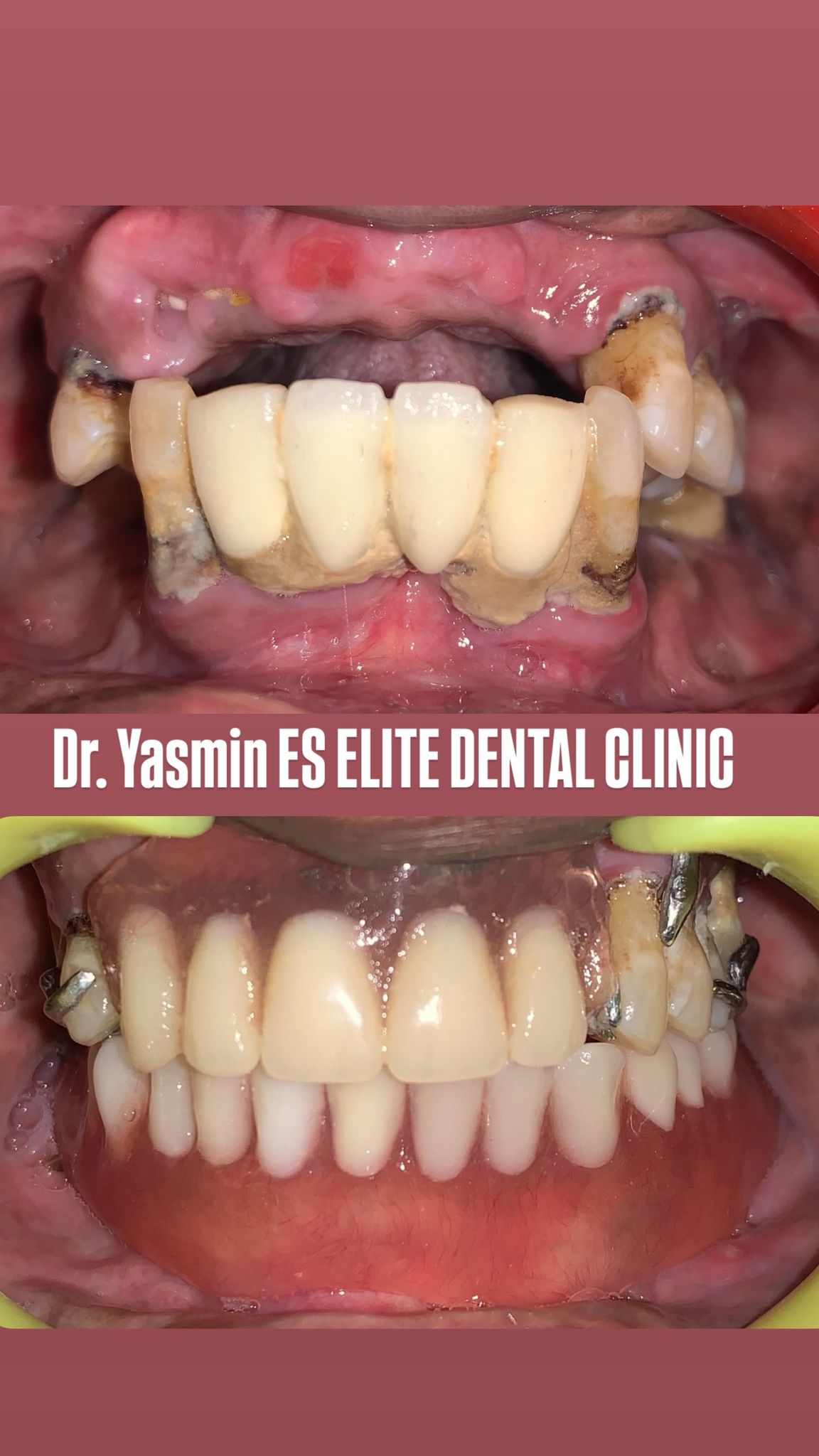 Pre-op — anterior tooth loss and spacing