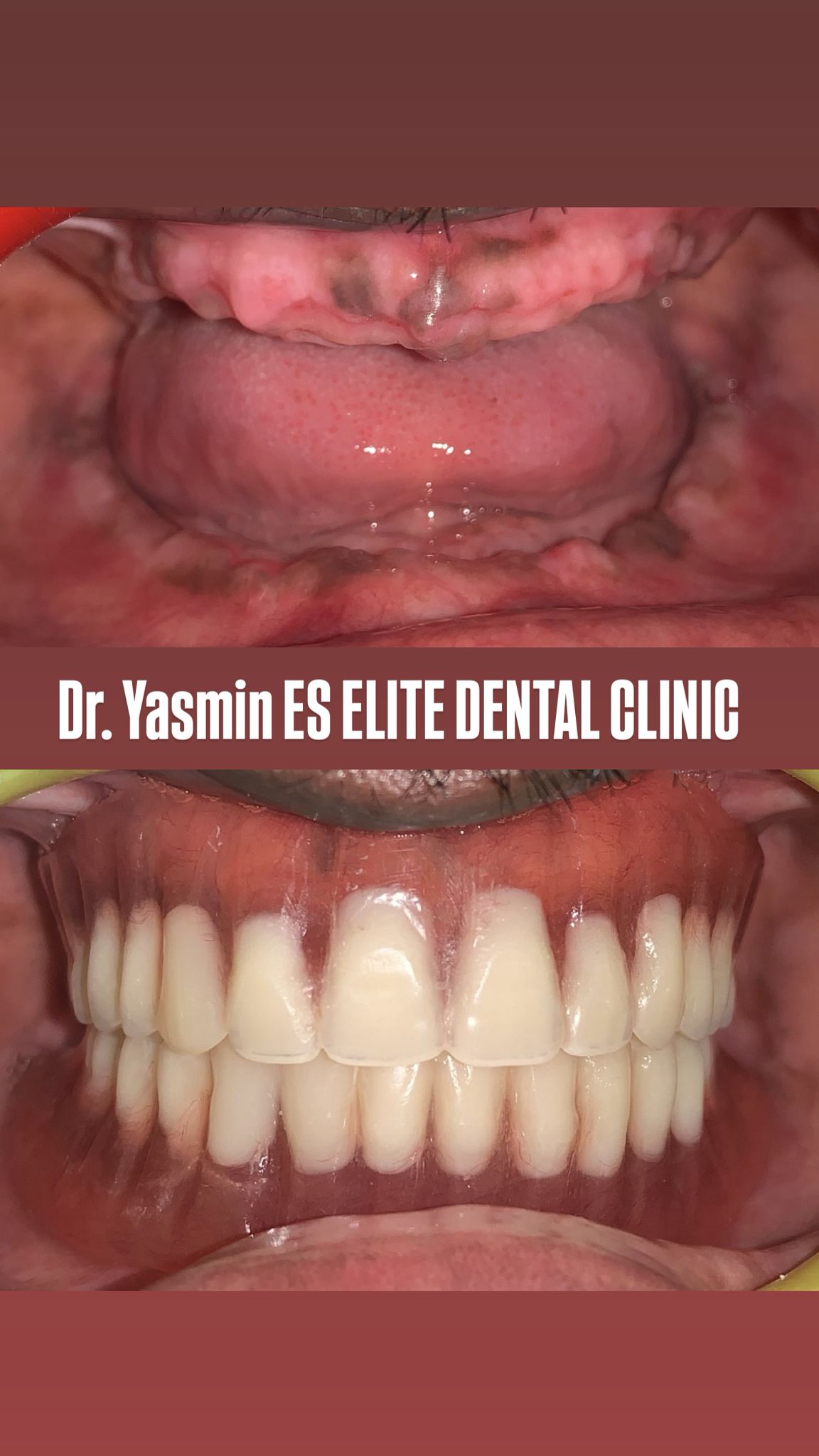 Post-op — provisional crowns in place