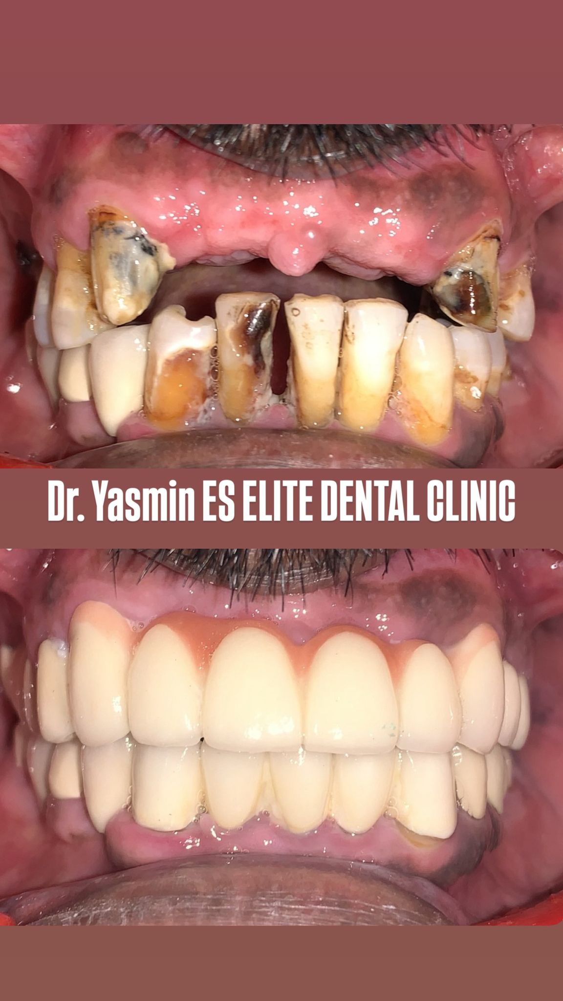 Surgical stage — maxillary anterior implants (placement)