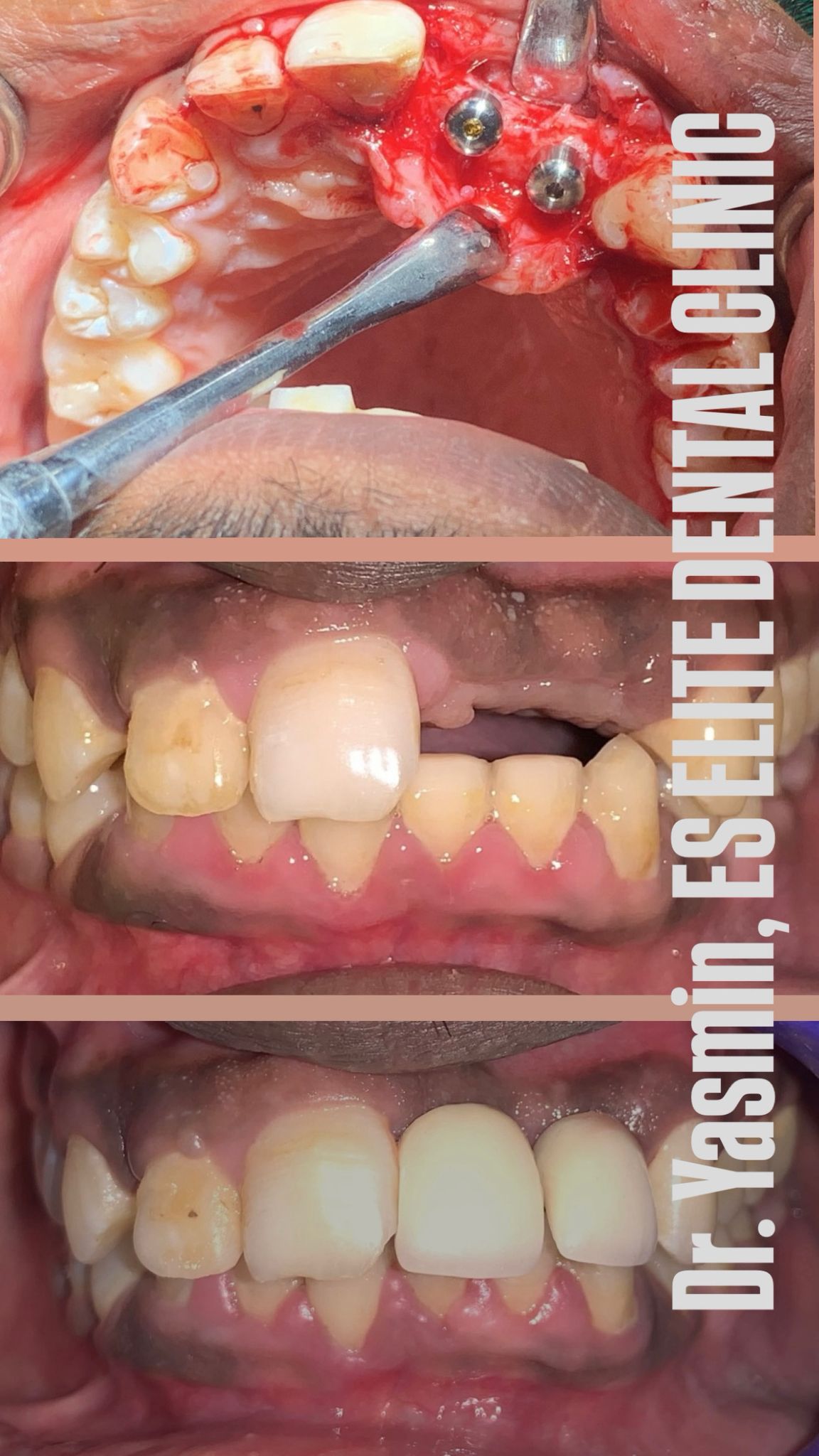 Dental implants and fixed crown